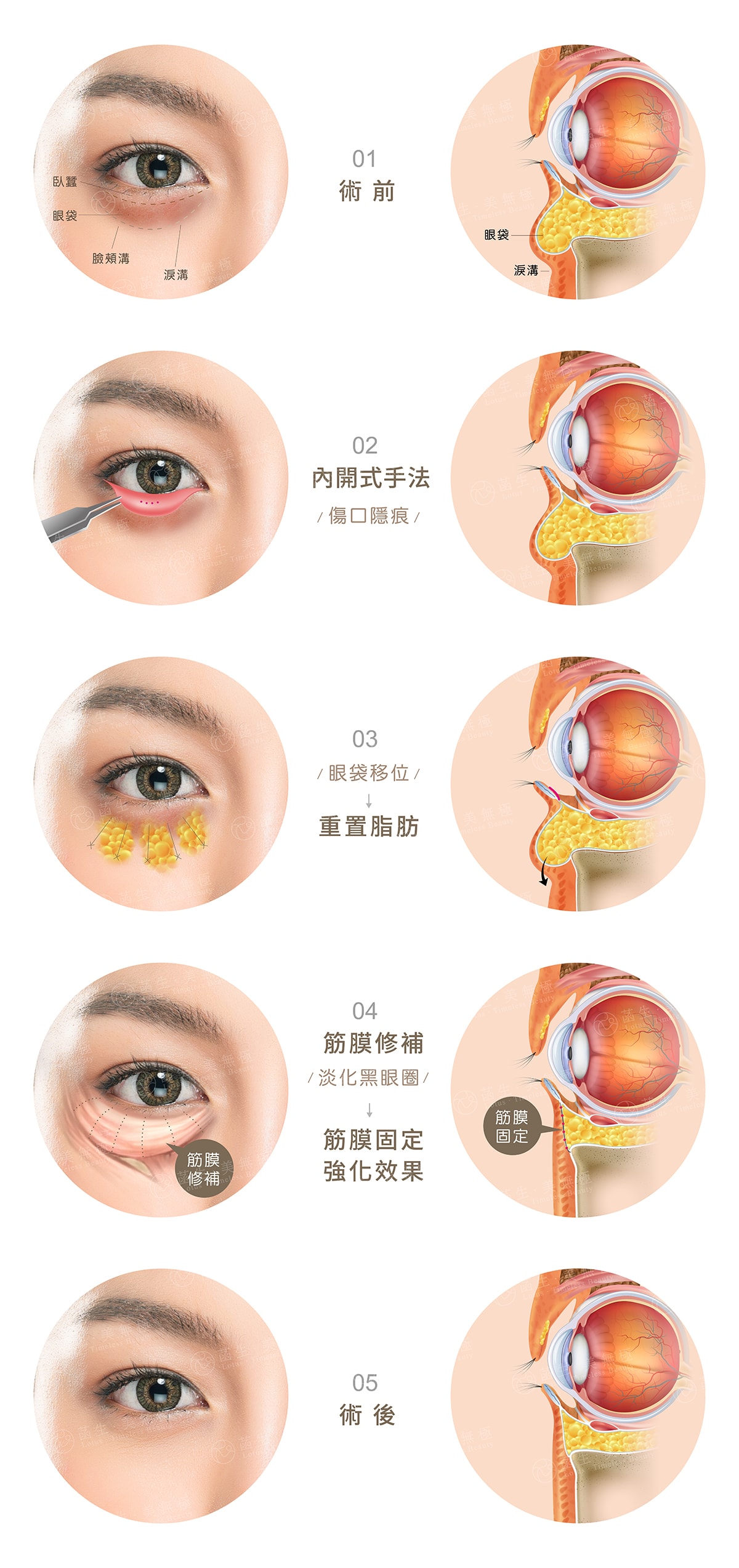 複合式眼袋手術