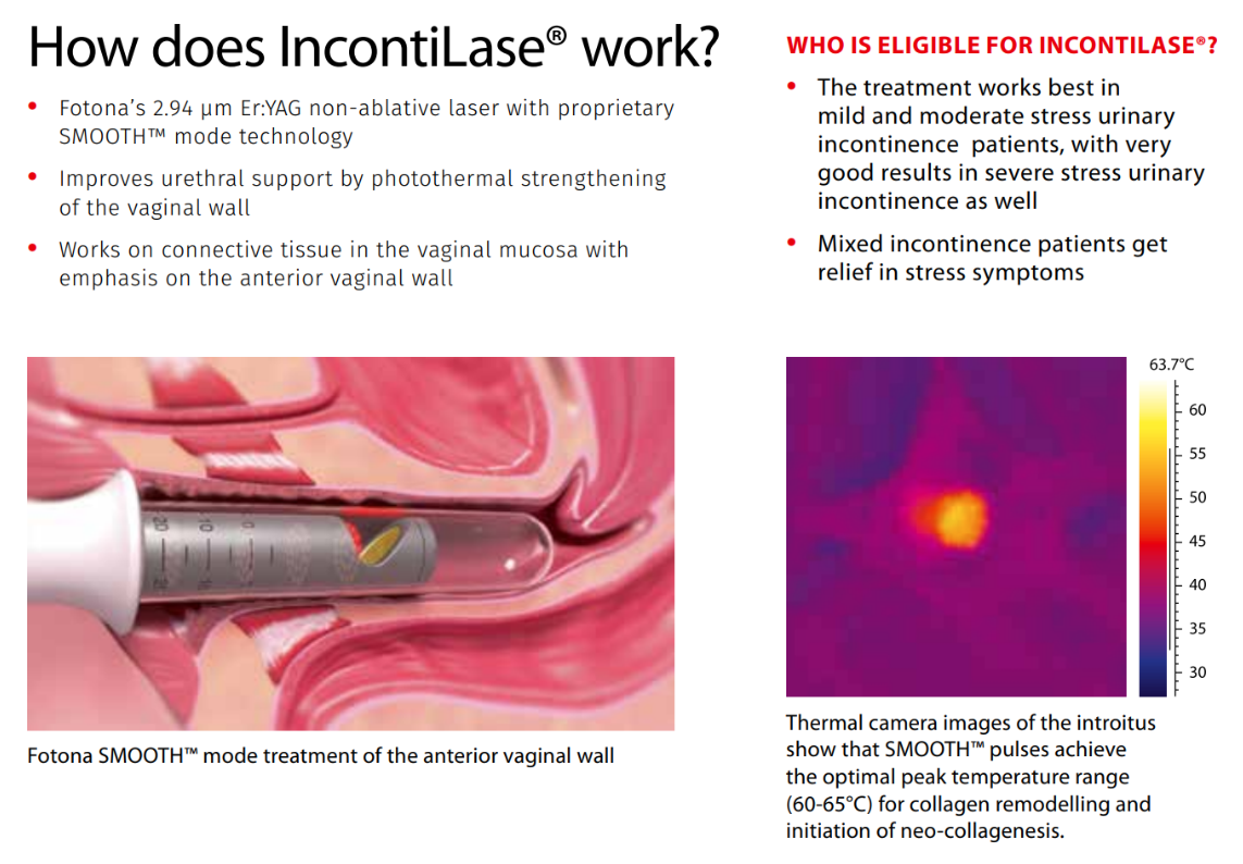 G 緊雷射是什麼